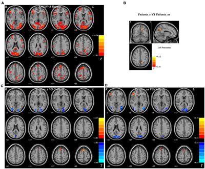 Shared and differential fractional amplitude of low-frequency fluctuation patterns at rest in major depressive disorders with or without sleep disturbance